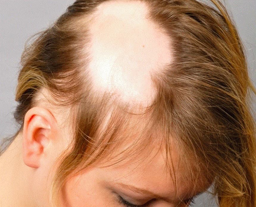 Read more about the article Alopecia androgenética feminina